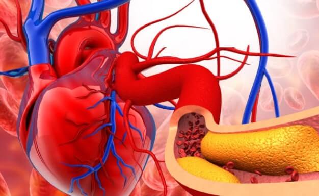 сърце и артерия с плаки и труден преход на червени кръвни телца