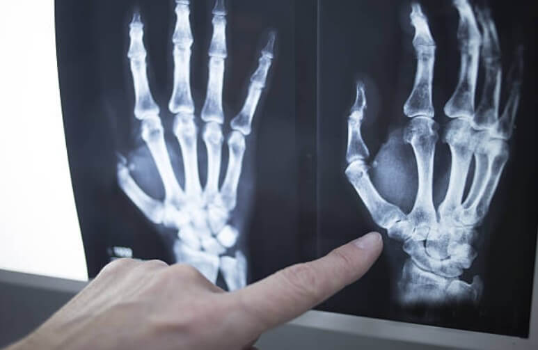 рентгенова снимка на ръце